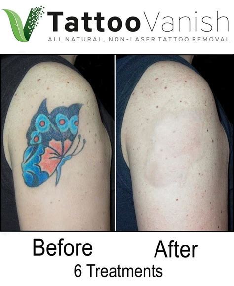 Tattoo Removal