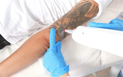 Tattoo removal aftercare