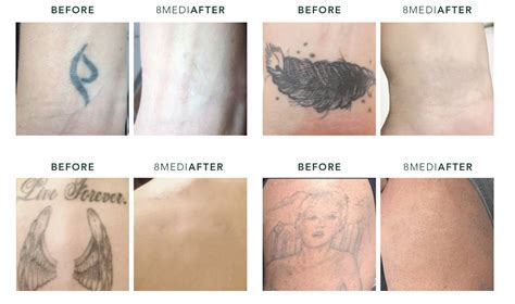 Tattoo Removal And Correction