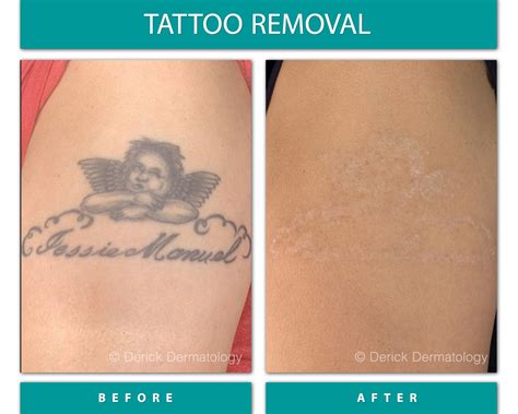 Tattoo Removal Before And After