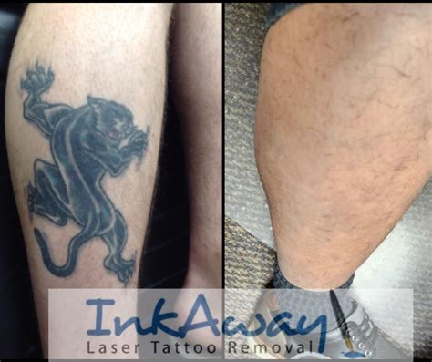 Tattoo Removal Orlando