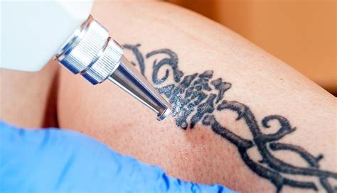 Tattoo Removal Process