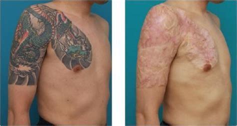 Tattoo Removal Risks