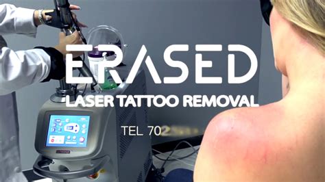 Tattoo Removal Technology