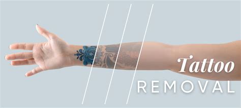 Tattoo Removal in Columbia Mo