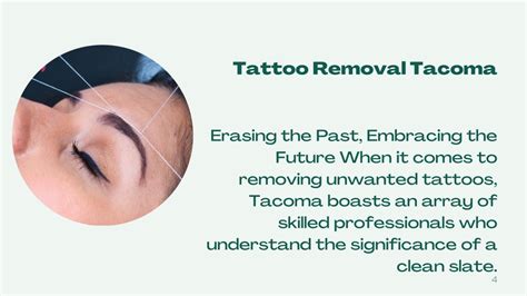 Tattoo Removal in Tacoma