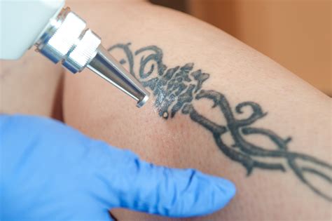 Tattoo Removal