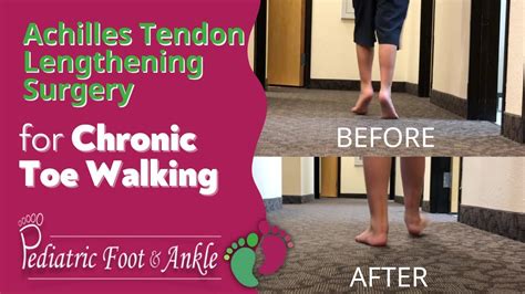 Toe Walks for Achilles Tendon