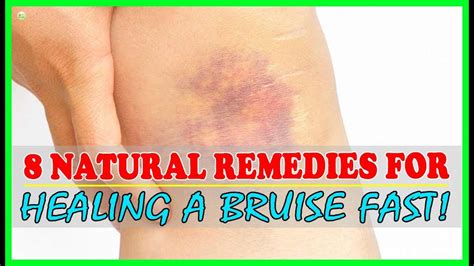 Treatment Options for Bruising