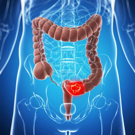 Types of Colon Cancer