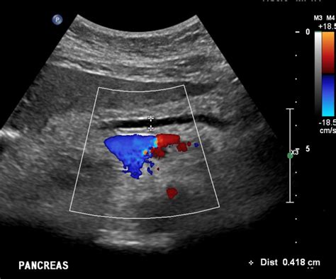 Ultrasound Image