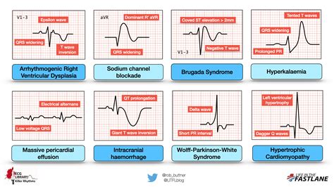 Understanding ECG Leads Example