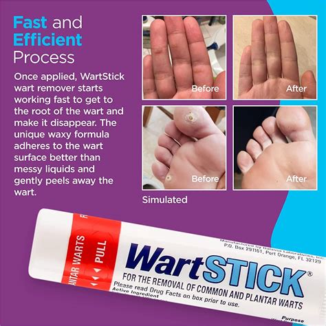 Understanding Wart Sticks