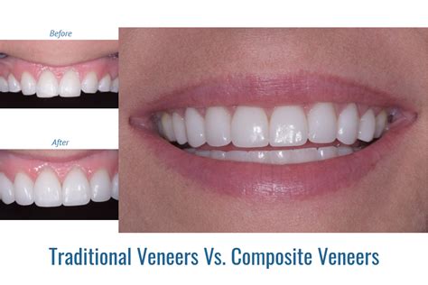 Comparing veneer costs with other materials