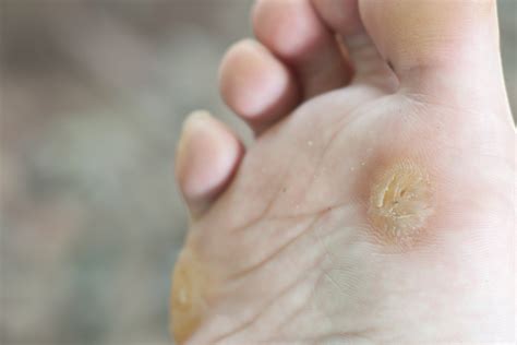 Wart Prevention Tips