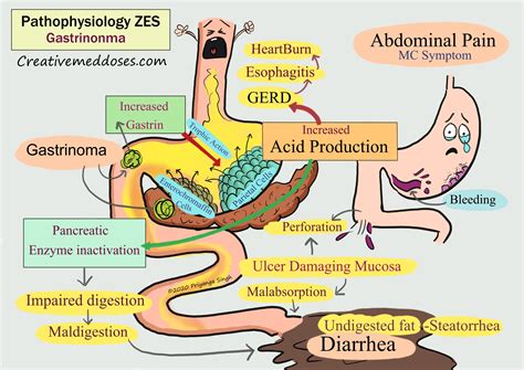 Zollinger-Ellison Syndrome