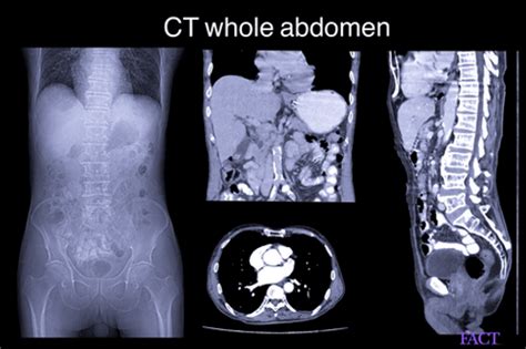 Abdomen scan results