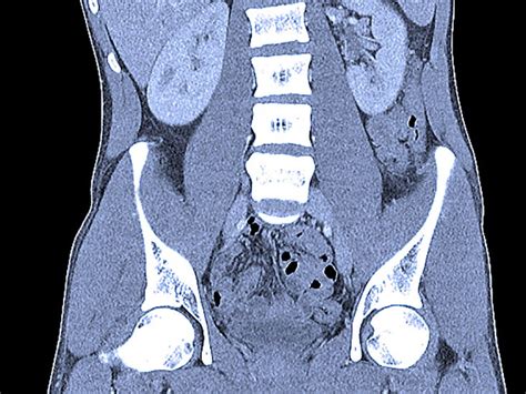 Abdominal CT scan image