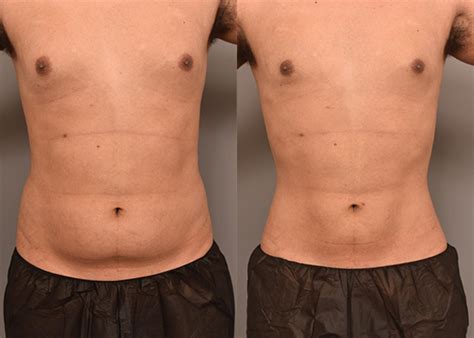 Abdominal Lipo After