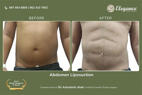 Abdominal Lipo Before and After