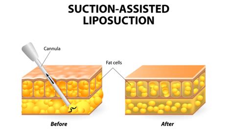 Abdominal Lipo Risks