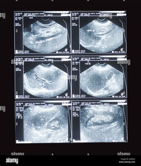 Abdominal Sonography