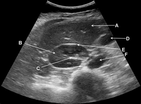 Abdominal ultrasound image