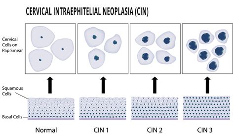 Description of Abnormal Pap Smear Image 1