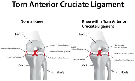 ACL injury diagram