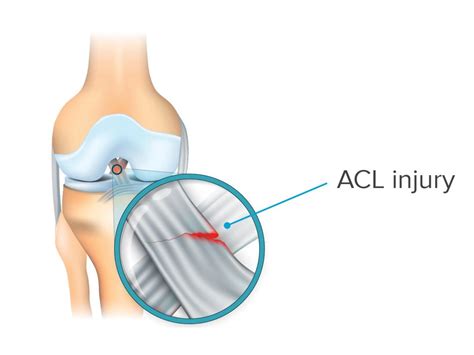 Acl injury diagnosis