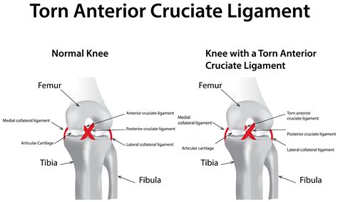 Acl injury diagnosis