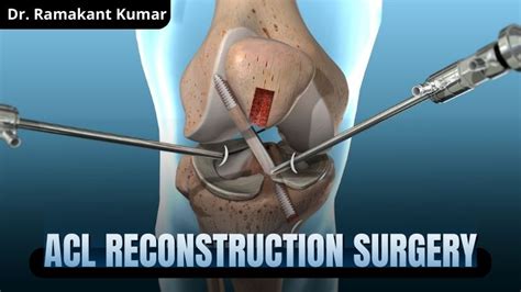 Acl injury surgery