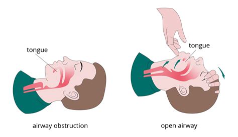 Airway management technique