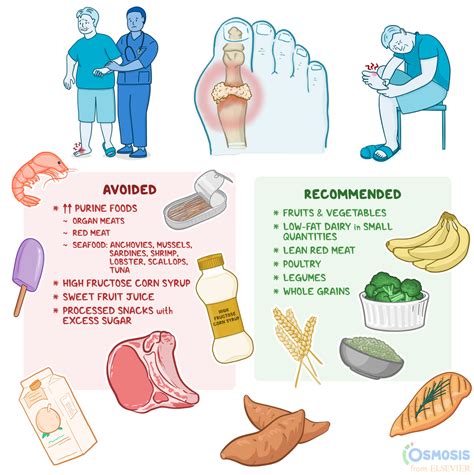 Alcohol to Avoid for Gout Diet