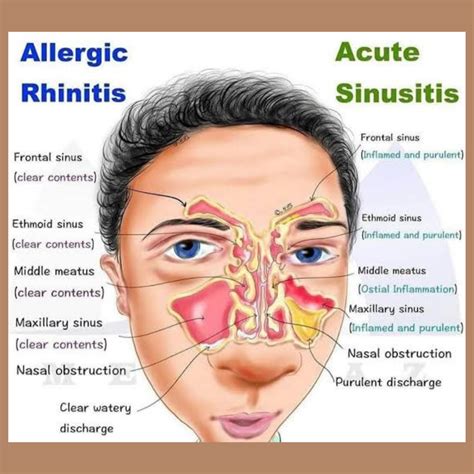 Allergic rhinitis symptoms