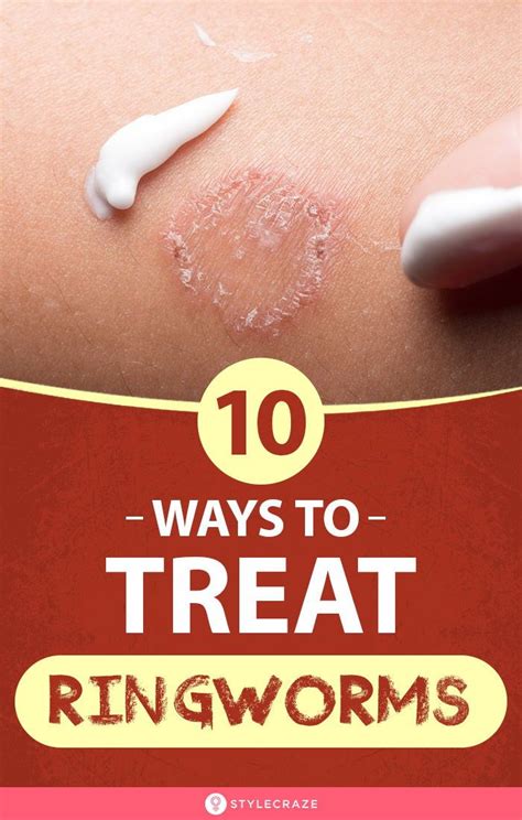 Alternative treatments for ringworm