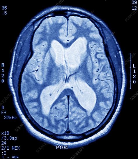 Alzheimer's brain scans