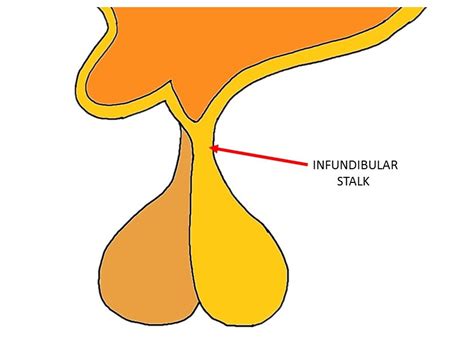 Anatomical Infundibulum