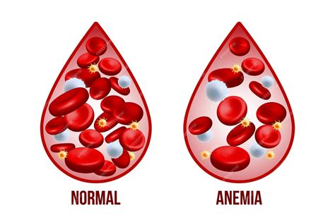 Anemia Causes