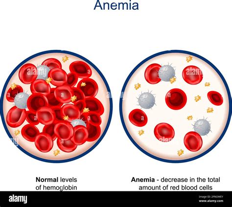 Anemia Red Blood Cells