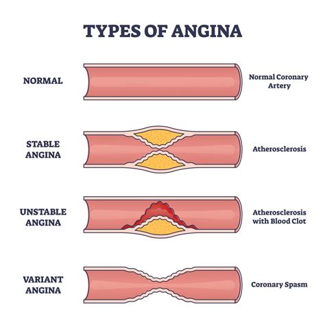 Angina Treatment