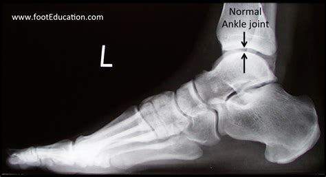 Ankle Arthritis