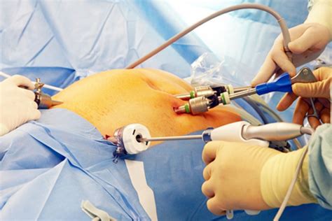 Appendicitis surgery