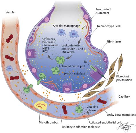 ARDS Pathophysiology