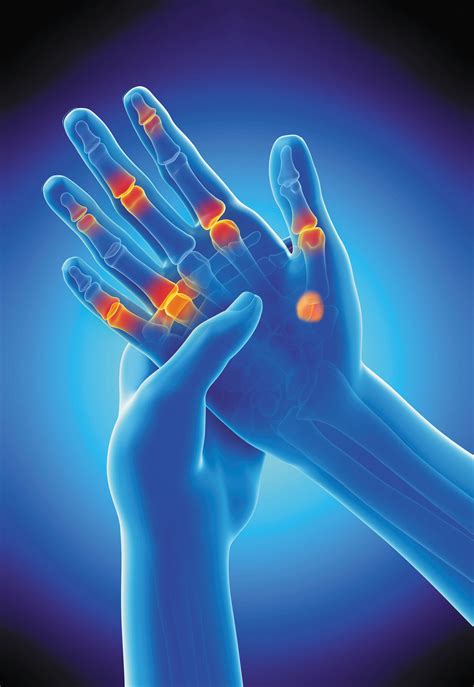 Rheumatoid Arthritis Joint Pain