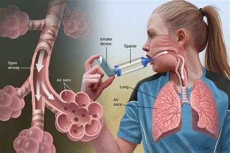 Asthma symptoms