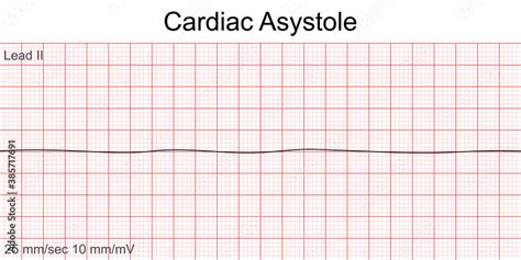 Asystole EKG