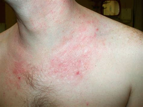 Atopic dermatitis symptoms