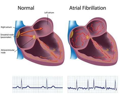 Atrial Fibrillation illustration