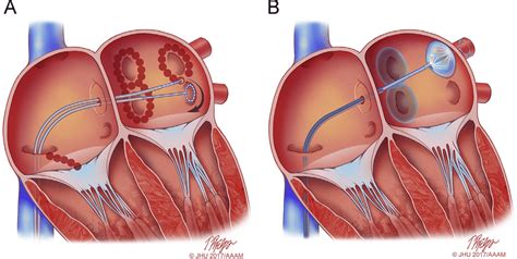 Atrial Fibrillation catheter ablation